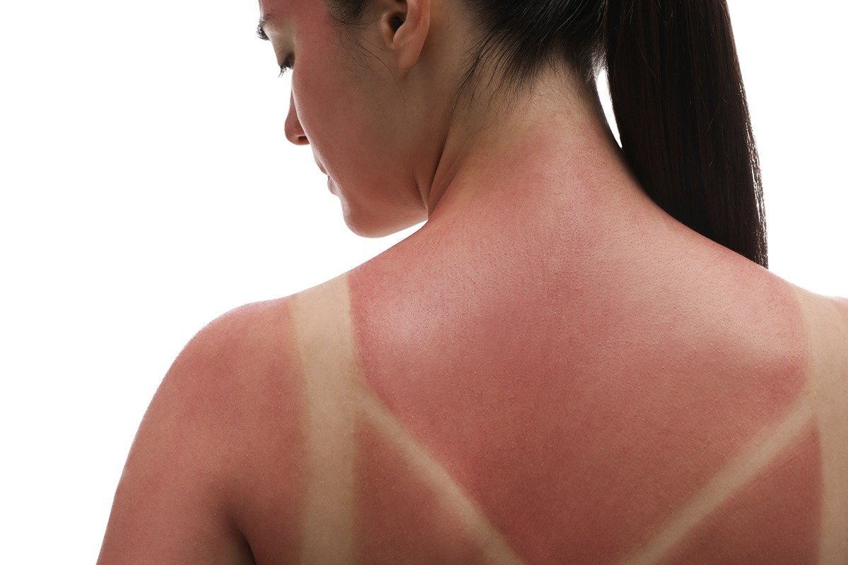 9 Sunburn Remedies That Cool Down Your Fried Skin