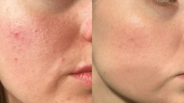 11 Ways to Get Rid of Textured Skin on Face — From Bumpy to Baby Smooth